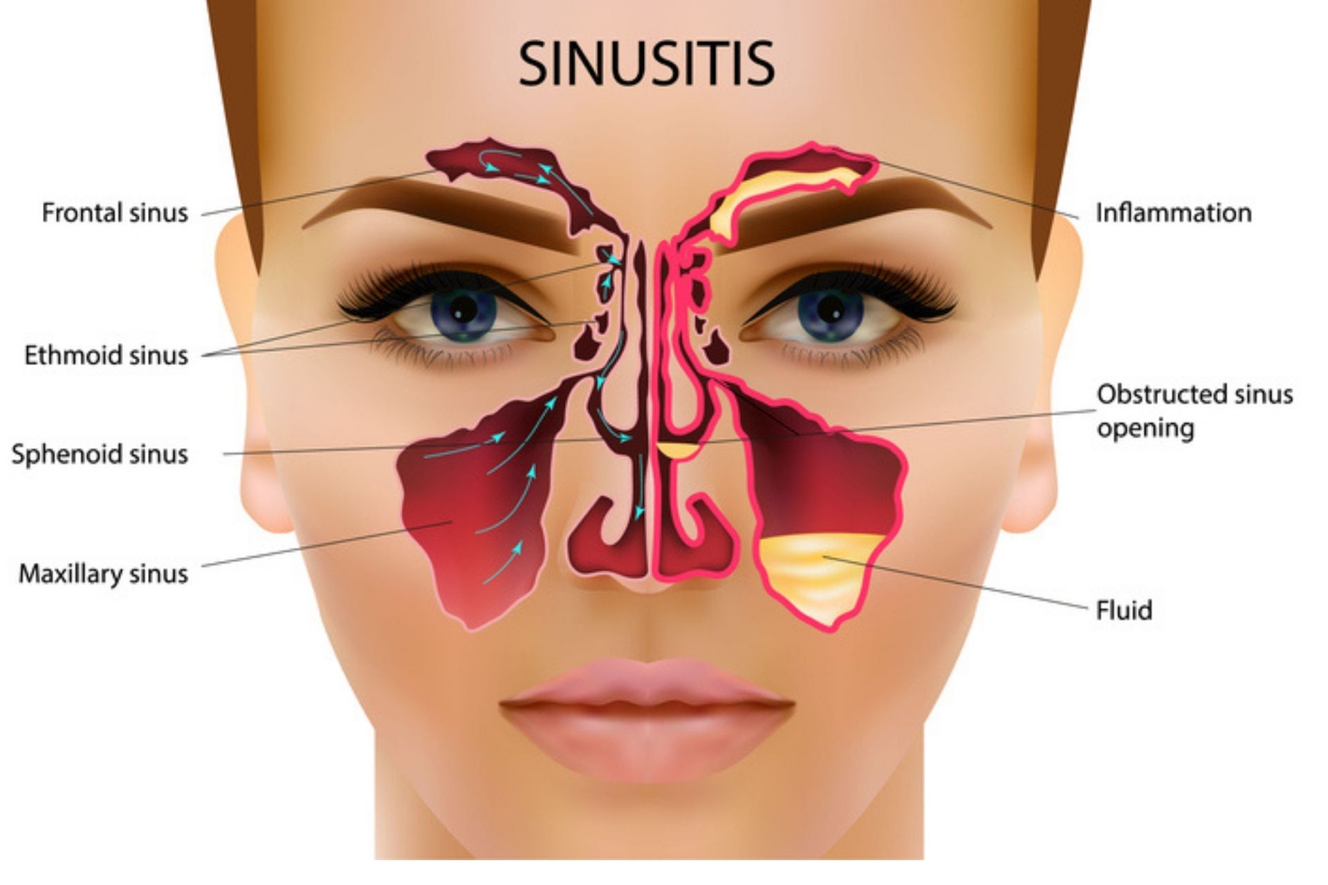 SInus-Infection-Prescription-Symptoms-Treatment-Online-Doctor