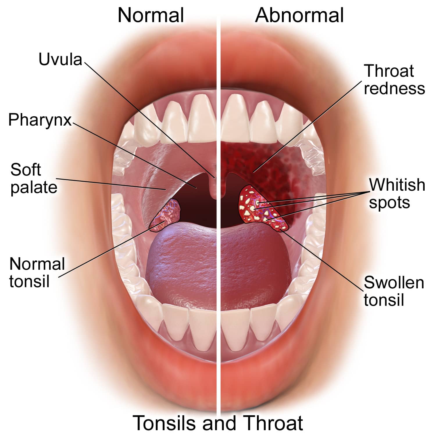 Strep-Throat-Sick-Symptoms